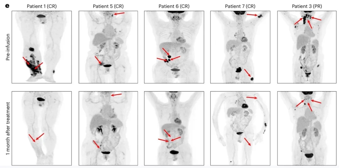 CD19-BBz CAR-NK细胞疗法治疗淋巴瘤的效果