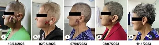 恩曲替尼治疗巨大唾液腺肿瘤的效果