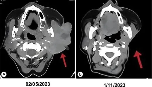 恩曲替尼治疗巨大唾液腺肿瘤的效果