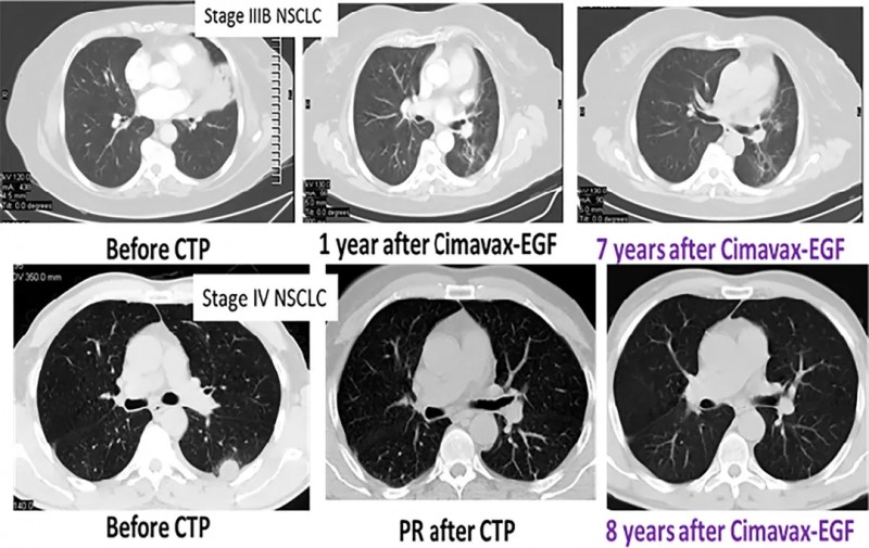 CIMAvax-EGF疫苗治疗肺癌的效果
