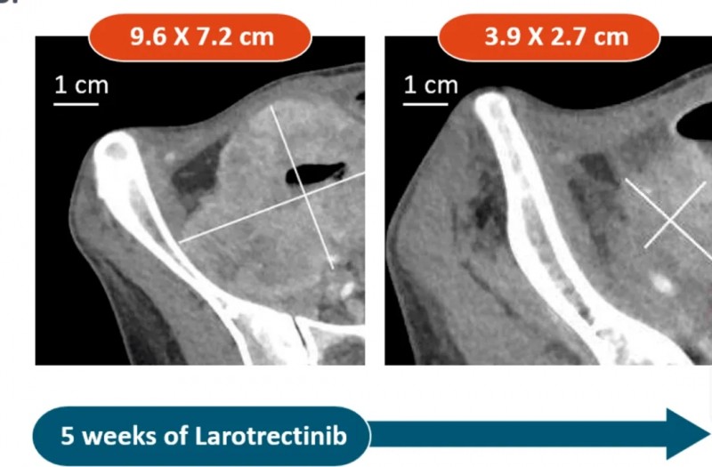 拉罗替你治疗结直肠癌的患者