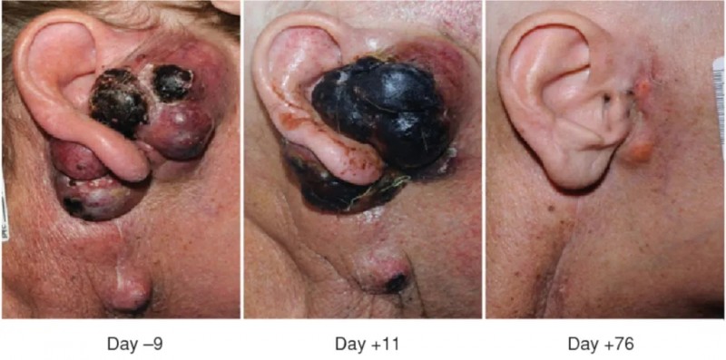 Lifileucel治疗耳部黑色素瘤的效果