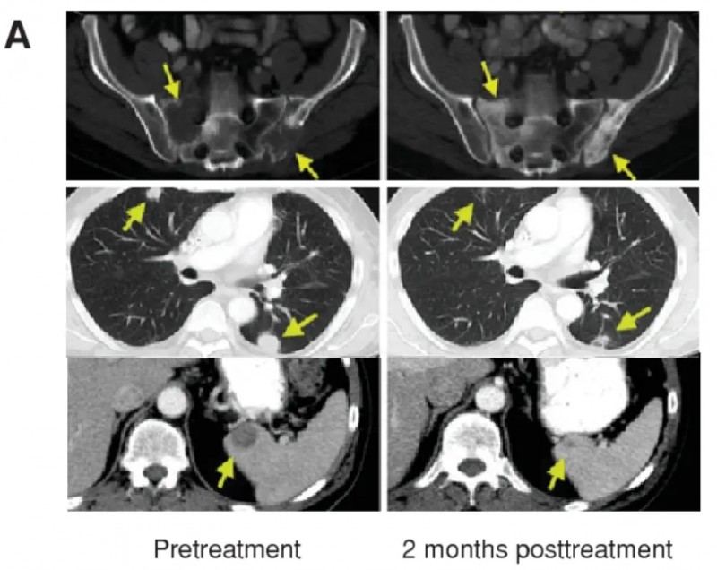 Lifileucel治疗黑色素瘤的效果