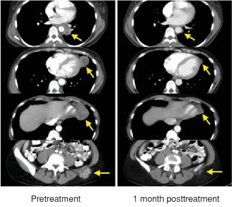 Lifileucel治疗黑色素瘤的效果