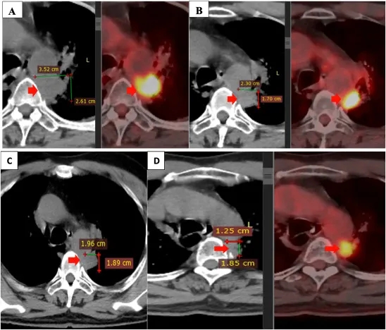 NK细胞疗法治疗肺癌的效果
