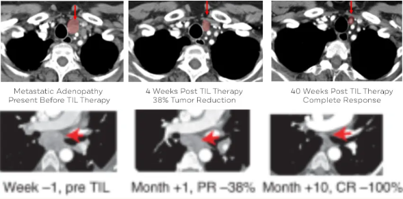 lifileucel治疗肺癌的效果