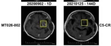 CAR-T细胞疗法治疗高级别脑胶质瘤的效果