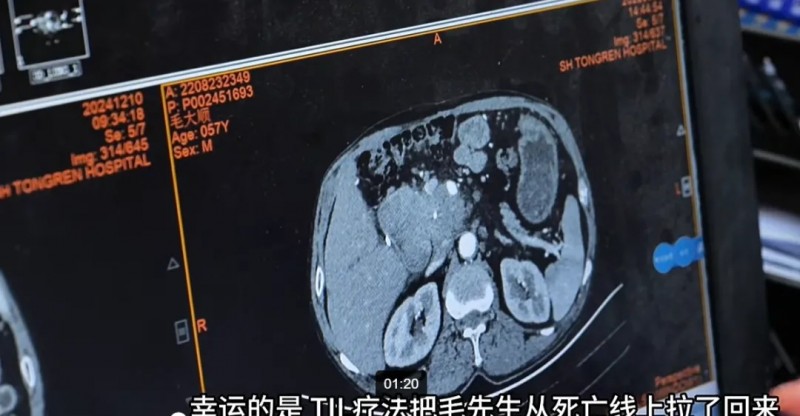 TIL细胞疗法治疗胰腺癌的效果