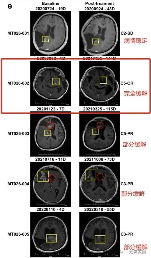 80%肿瘤缩小、100%控制!国研CAR-T用鞘内注射杀入大脑,脑胶质瘤生存期突破33个月