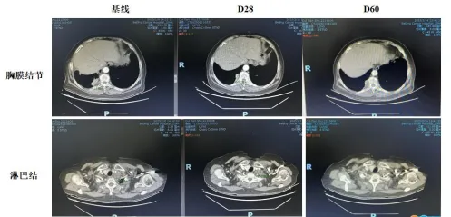 终于有药了！胰腺癌首款泛RAS靶向药获批上市，覆盖90%以上患者！