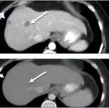 结直肠癌基因检测,直肠癌基因检测,结肠癌基因检测,Found