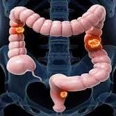 结直肠癌吃什么药,结肠癌药物,直肠癌药物,治疗肠癌的药