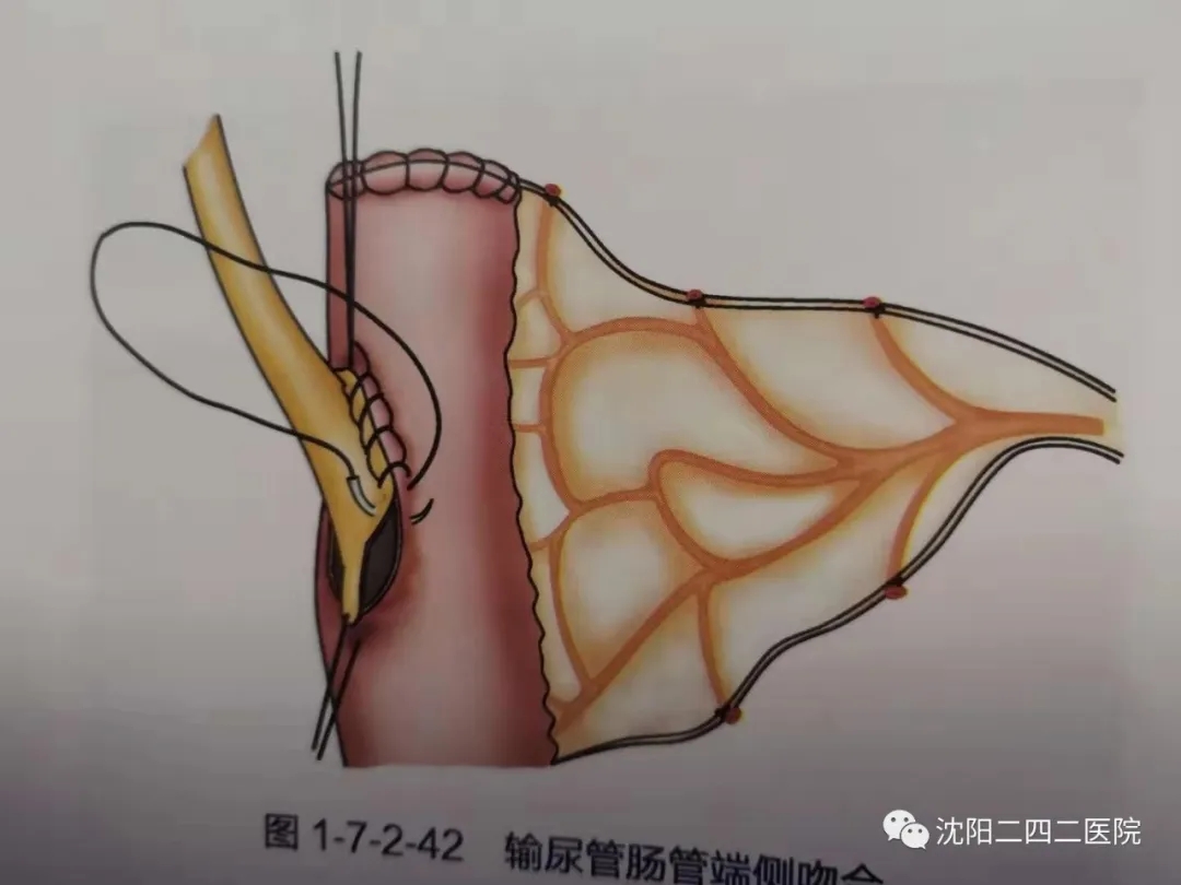 膀胱癌根治术+双侧输尿管皮肤造口术或原位膀胱术