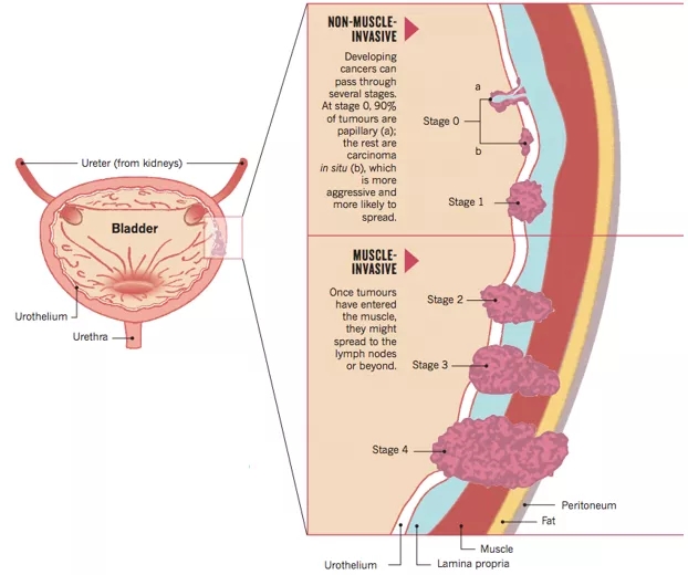 膀胱癌：非基层浸润72%，约67%为低级别低转移性