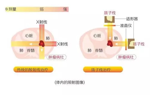 质子治疗和传统放疗射线对比