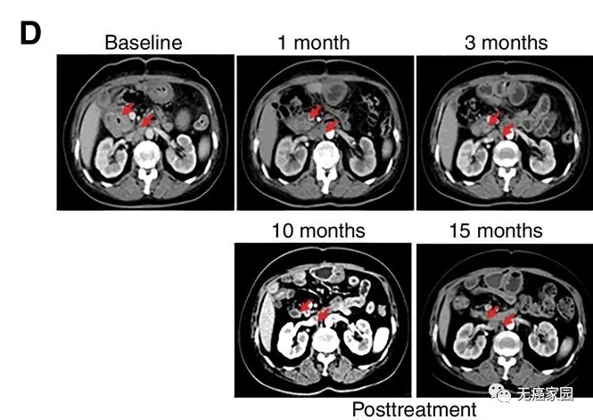 CAR-T疗法治疗胆道癌的效果 CAR-T疗法治疗胆道癌的效果