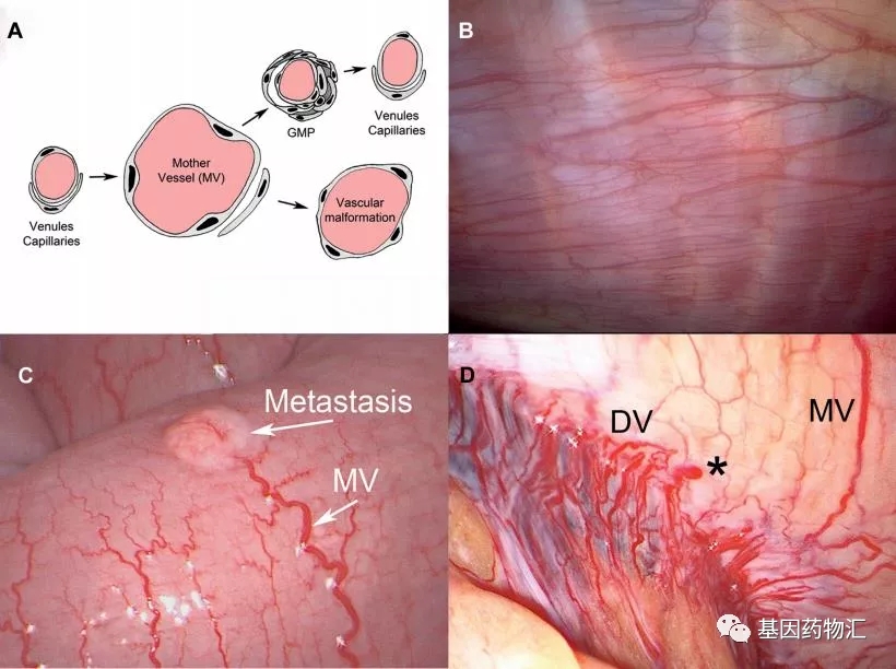 癌性腹水腹部内部