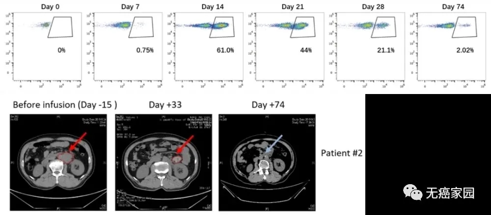 新型CAR-T细胞在患者体内扩增 新型CAR-T细胞在患者体内扩增