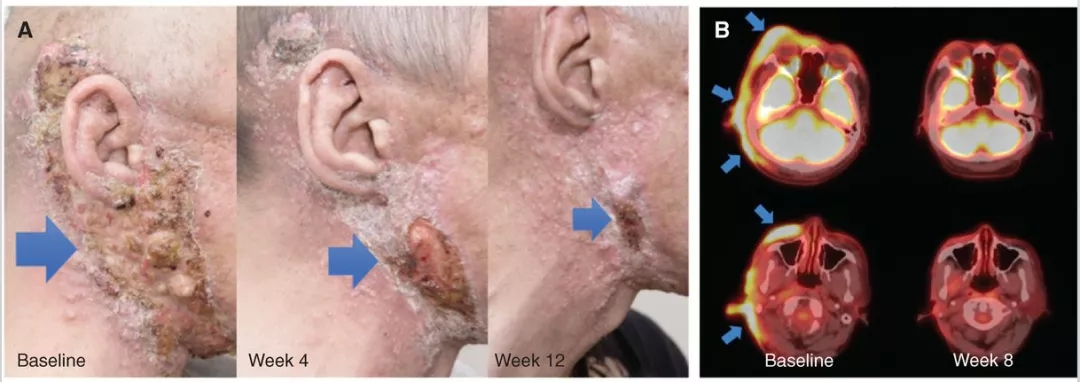 TPX-0005治疗NTRK融合的分泌性唾液腺癌效果