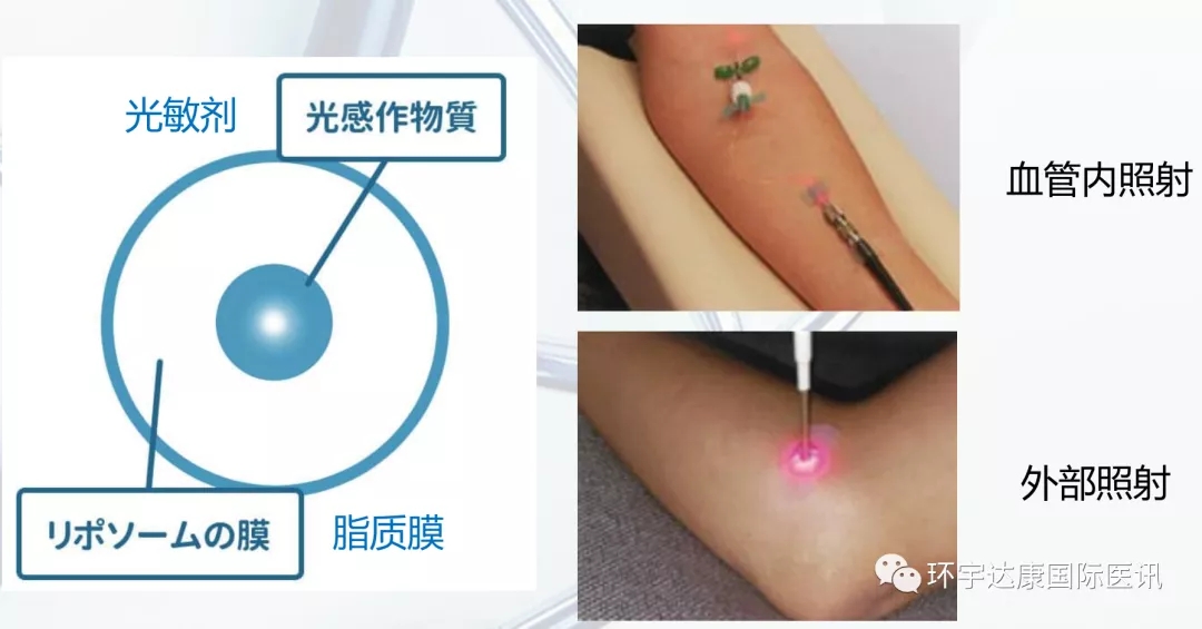 光免疫疗法 光免疫疗法