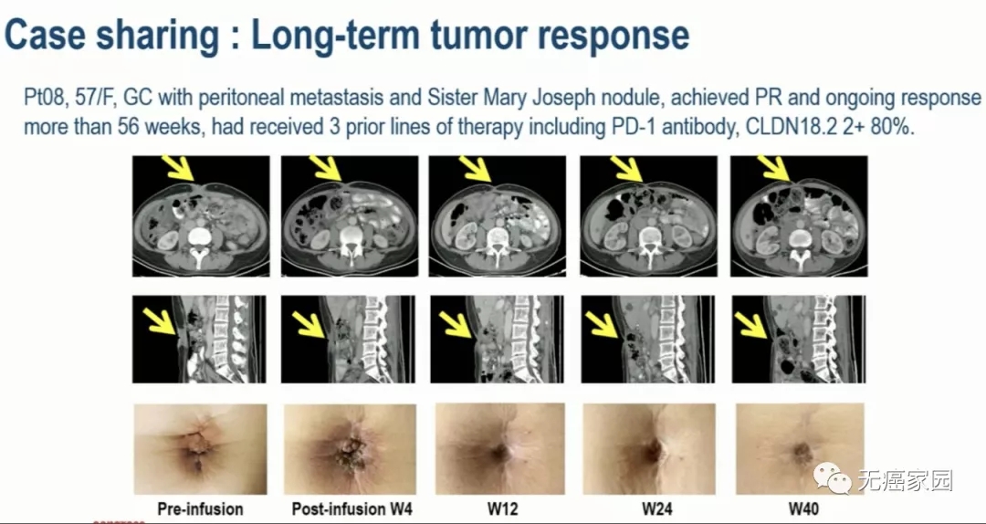 CAR-T疗法治疗女性胃癌的效果