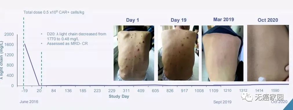 CAR-T细胞疗法治疗多发性骨髓瘤的效果 CAR-T细胞疗法治疗多发性骨髓瘤的效果