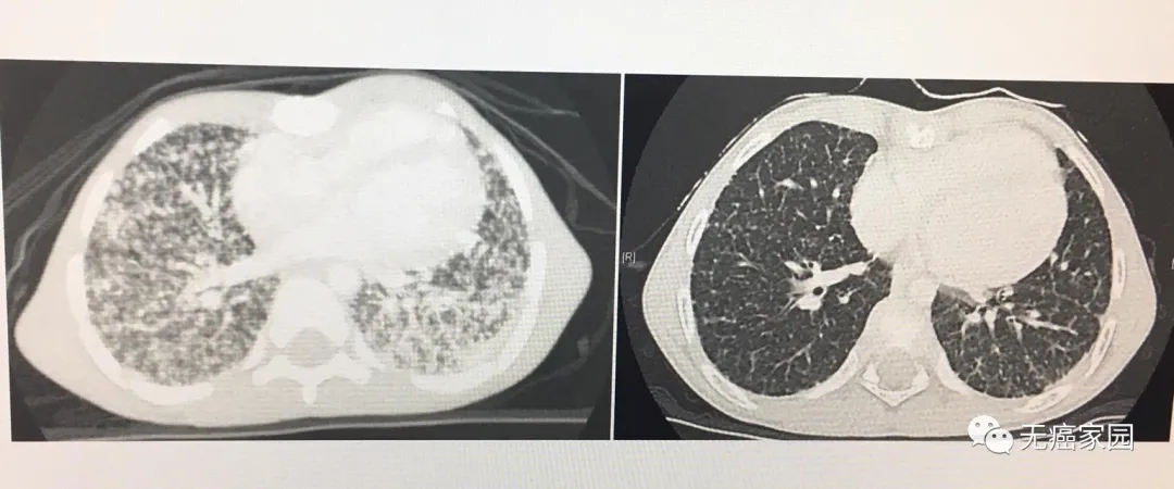 拉罗替尼治疗甲状腺癌的效果
