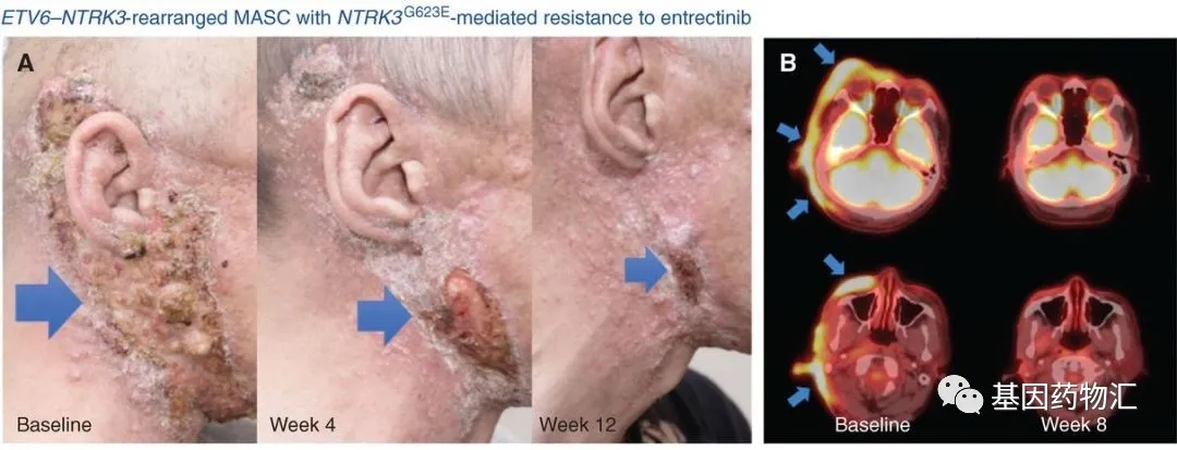 TPX-0005治疗唾液腺癌的效果 TPX-0005治疗唾液腺癌的效果