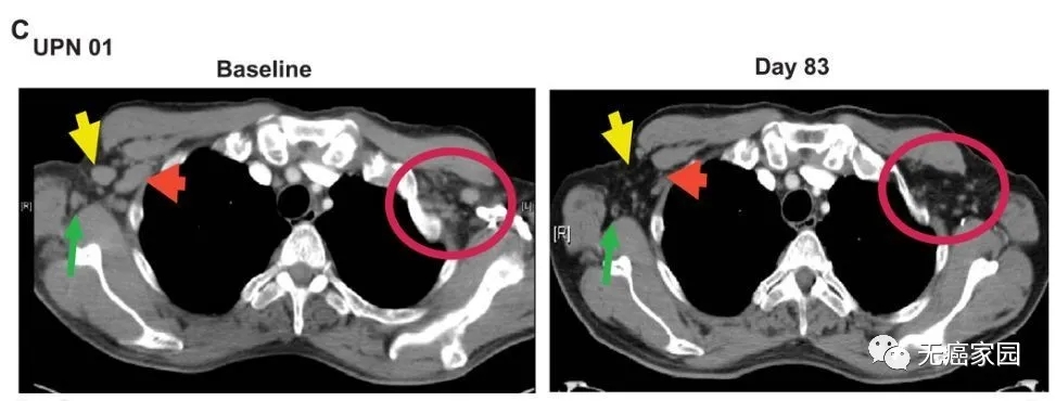 CAR-T治疗效果 CAR-T治疗效果