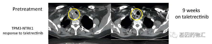 AB106治疗甲状腺乳头状癌的效果 AB106治疗甲状腺乳头状癌的效果