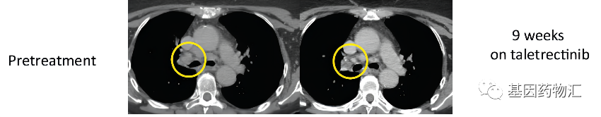 AB106治疗神经内分泌癌的效果 AB106治疗神经内分泌癌的效果