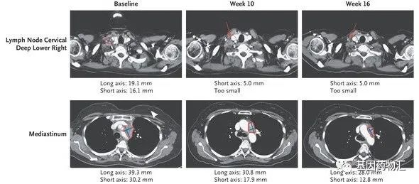 Sotorasib治疗非小细胞肺癌的效果 Sotorasib治疗非小细胞肺癌的效果
