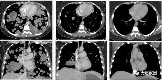 Larotrectinib治疗软组织肉瘤的效果 Larotrectinib治疗软组织肉瘤的效果