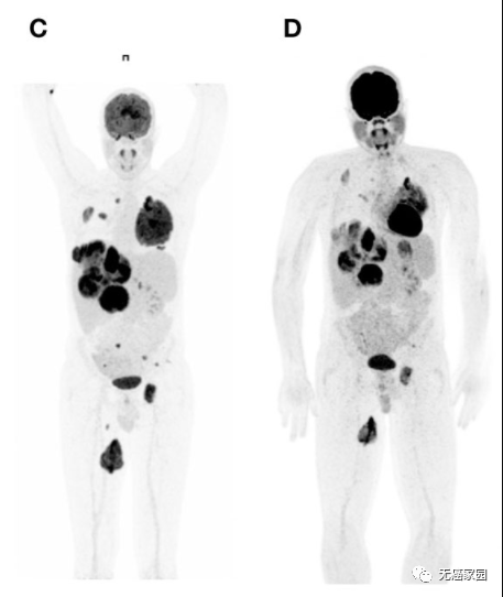 Larotrectinib治疗重排梭形细胞肿瘤的效果 Larotrectinib治疗重排梭形细胞肿瘤的效果