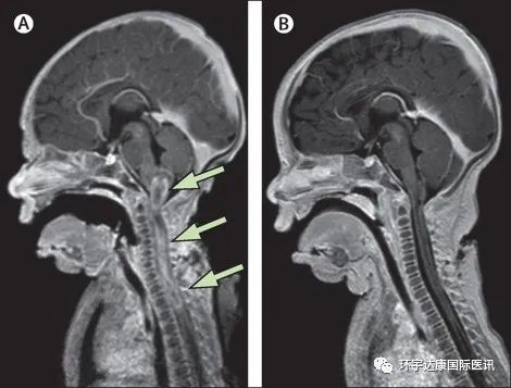 Larotrectinib治疗婴儿脊柱肿瘤的效果 Larotrectinib治疗婴儿脊柱肿瘤的效果
