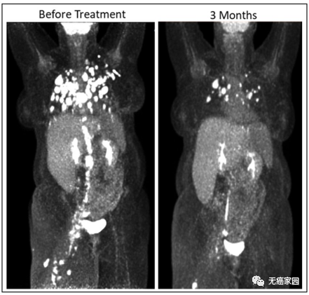 TCR-T细胞治疗外阴癌的效果 TCR-T细胞治疗外阴癌的效果