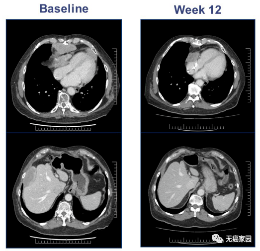TCR-T疗法治疗滑膜肉瘤的效果 TCR-T疗法治疗滑膜肉瘤的效果