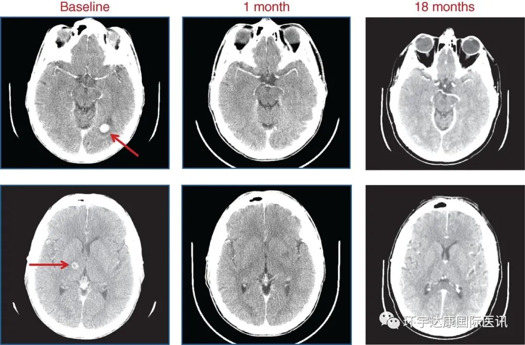 恩曲替尼治疗肺癌脑转移的效果 恩曲替尼治疗肺癌脑转移的效果