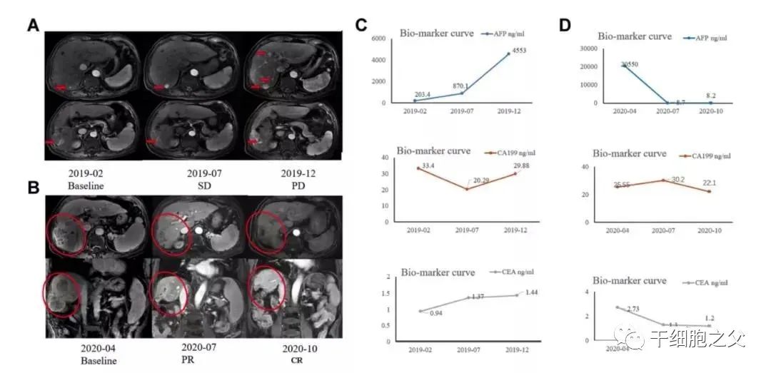 CIK细胞疗法治疗肝内胆管癌的效果 CIK细胞疗法治疗肝内胆管癌的效果