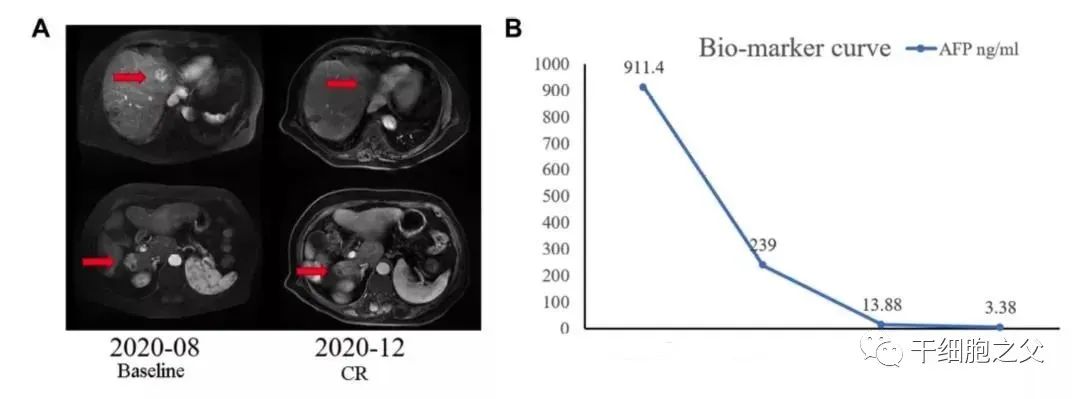 CIK细胞治疗肝癌的效果 CIK细胞治疗肝癌的效果