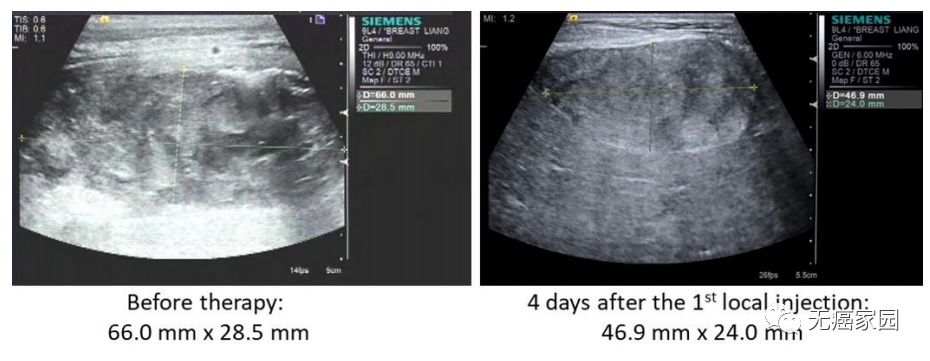 CAR-NK细胞降低肝转移病灶肿瘤负荷 CAR-NK细胞降低肝转移病灶肿瘤负荷