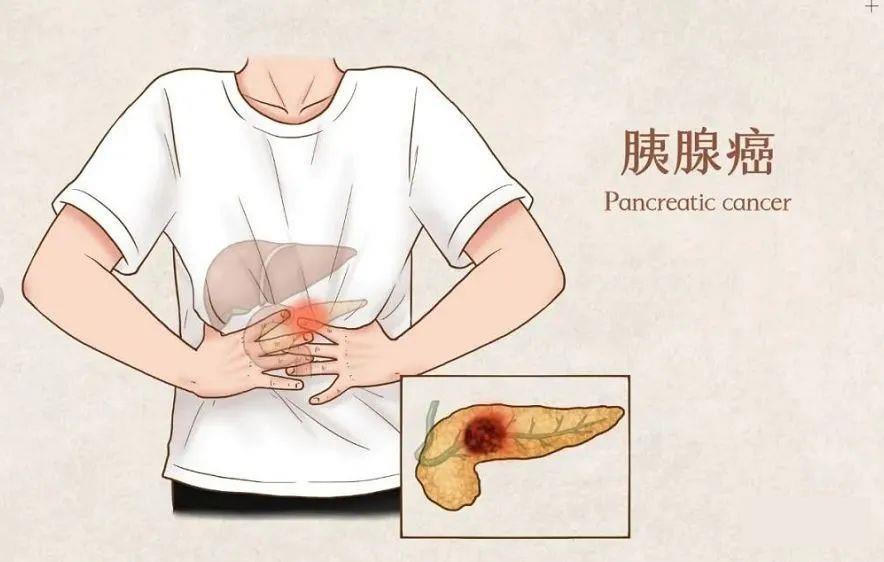 胰腺癌