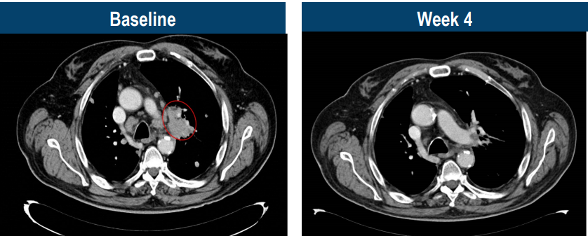 TCR-T疗法治疗头颈癌的效果 TCR-T疗法治疗头颈癌的效果