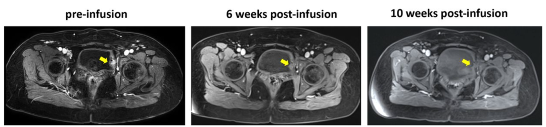 TIL疗法治疗宫颈癌的效果 TIL疗法治疗宫颈癌的效果