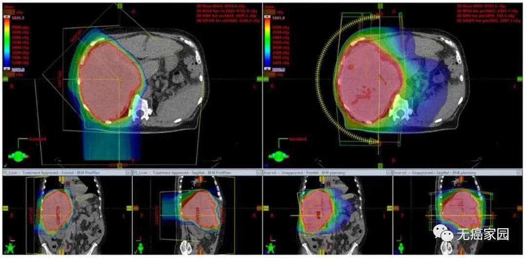 质子治疗肝癌的照射范围图