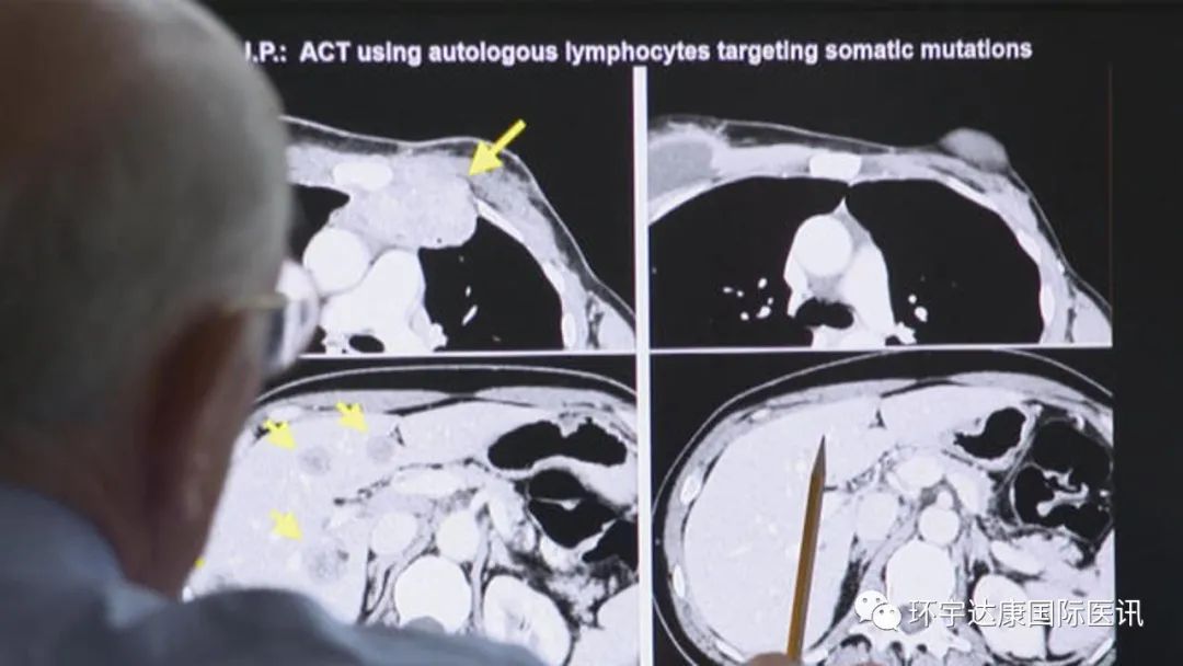 til疗法治疗乳腺癌的效果 til疗法治疗乳腺癌的效果