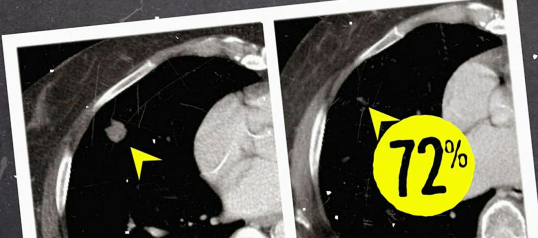 Ⅳ期胰腺 Ⅳ期胰腺