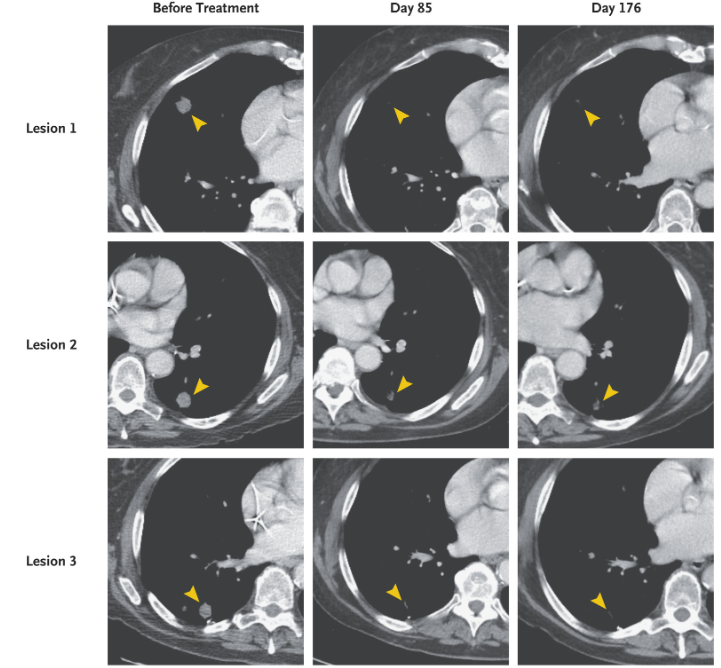 TCRT细胞疗法治疗效果 TCRT细胞疗法治疗效果