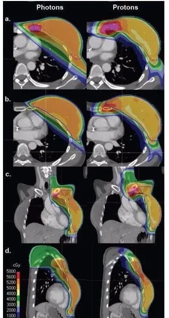 质子治疗和光子治疗乳腺癌对比