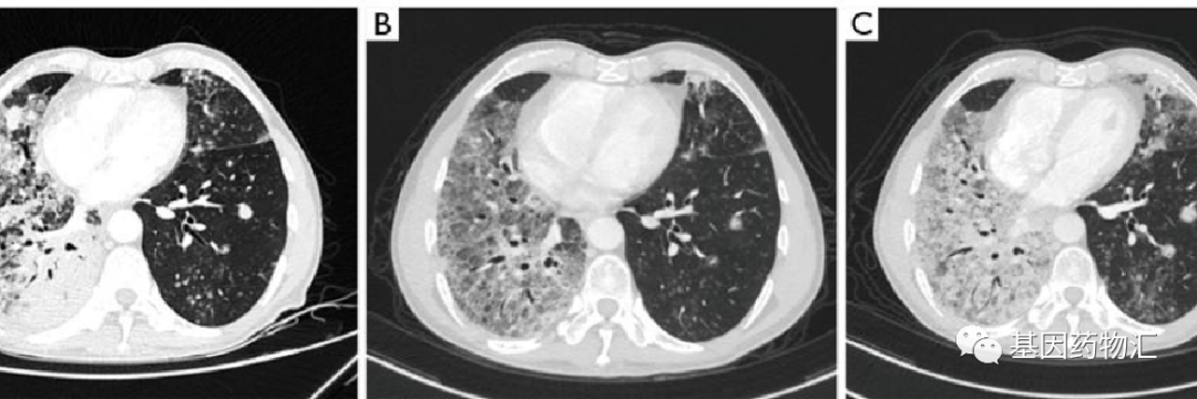 伏美替尼治疗效果 伏美替尼治疗效果